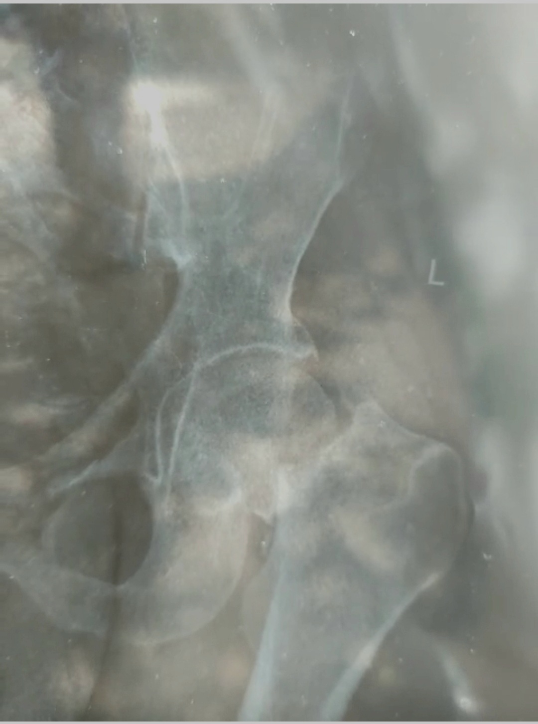 The kind of injuries we see and often neglected.  If the fracture is reduced, the healing will be good, and he can return to his activities around his home with the help of our physiotherapist.   